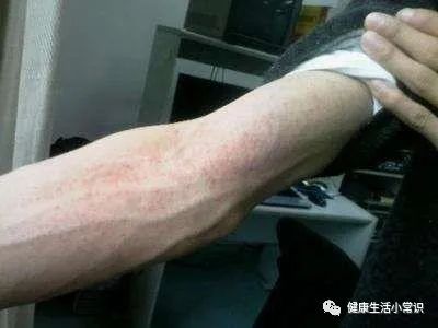 阿司匹林保健_亚健康阿司匹林_阿司匹林保健作用